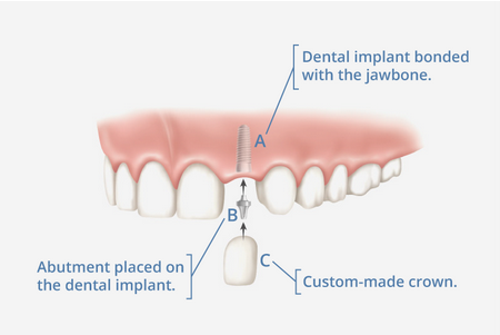 Dental Implants Katy, TX - Olim and Associates